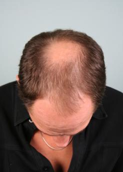 Before Hair Transplant&nbsp;Midscalp